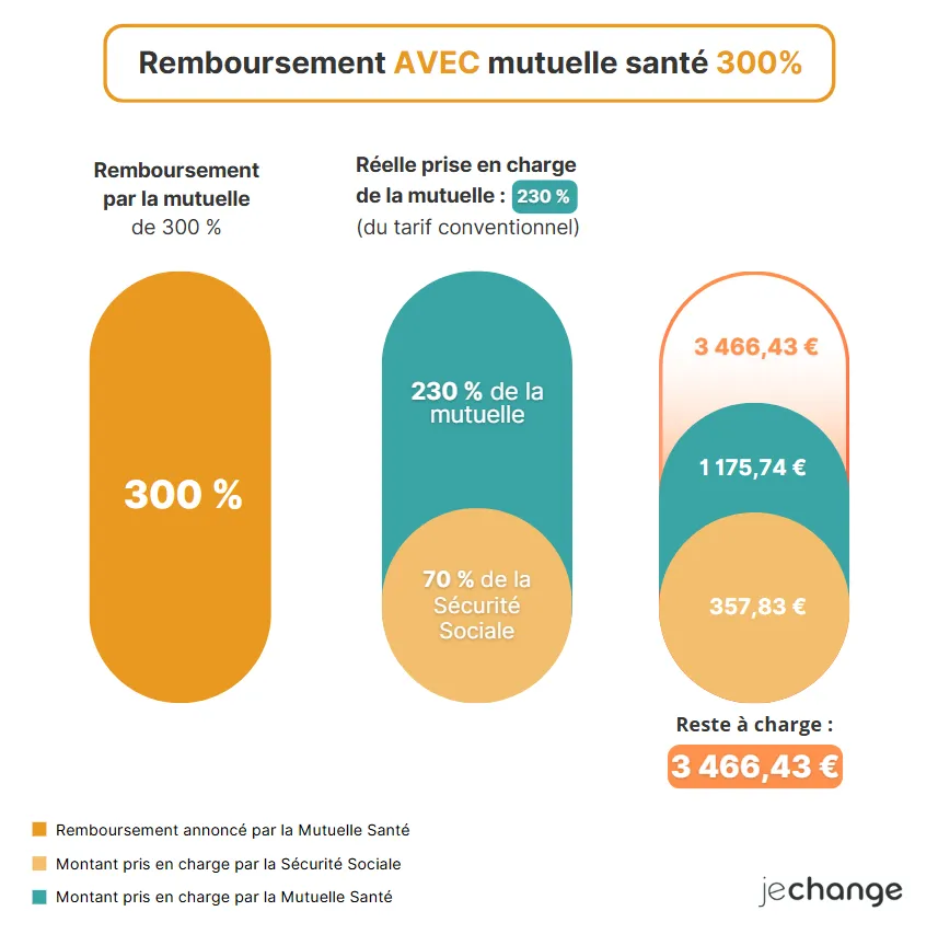 Schéma du remboursement d'une sleeve à 5 000 € avec une mutuelle à 300 %