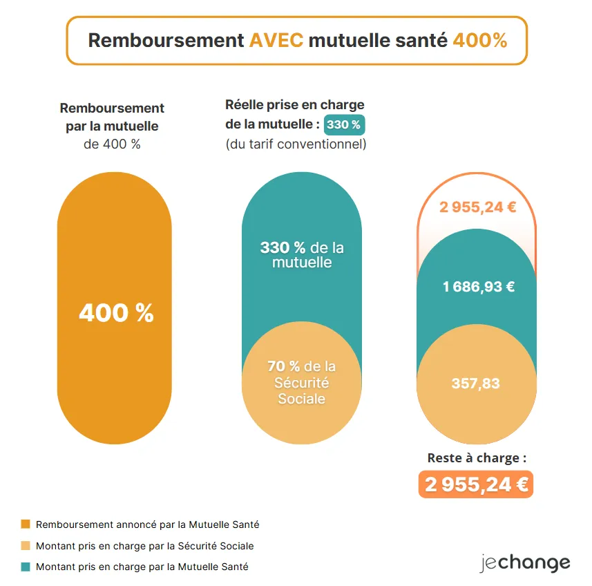 Schéma du remboursement d'une sleeve à 5 000 € avec une mutuelle à 400 %